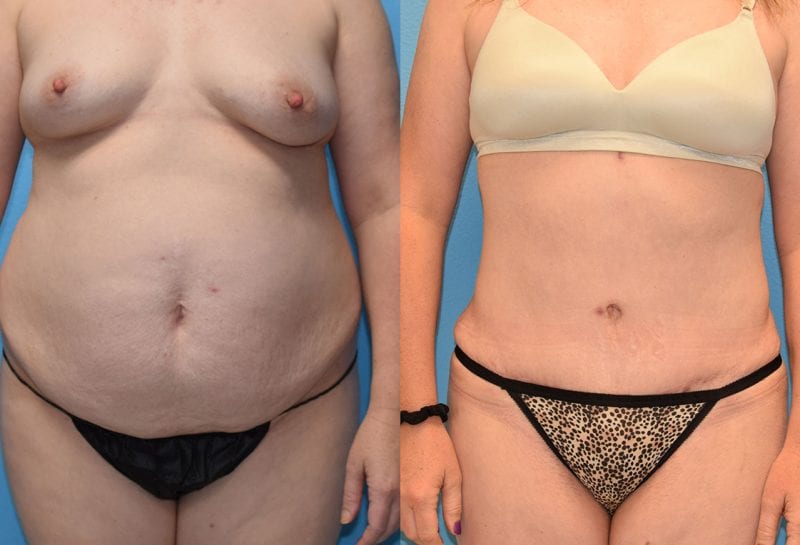 Tummy tuck results by Dr. Maningas at Maningas Cosmetic Surgery in Joplin, MO