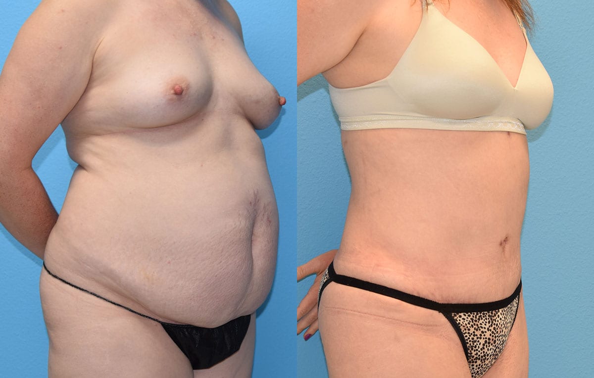 Tummy tuck results by Dr. Maningas at Maningas Cosmetic Surgery in Joplin, MO