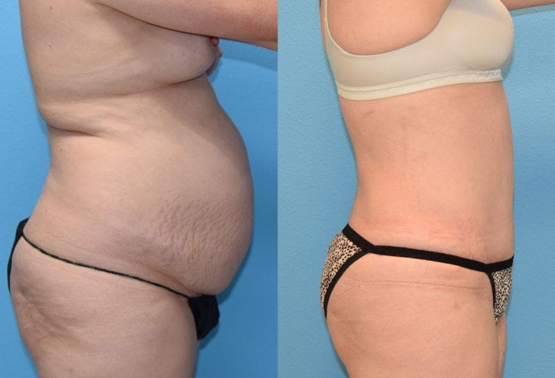 Tummy tuck results by Dr. Maningas at Maningas Cosmetic Surgery in Joplin, MO