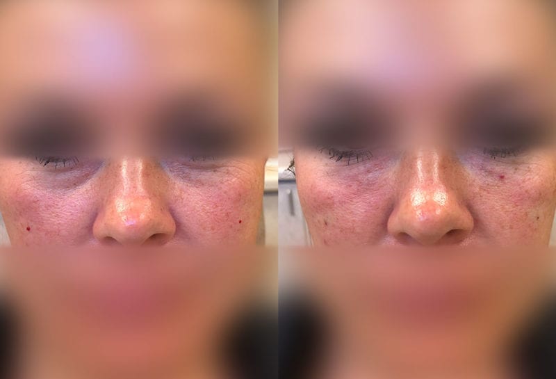 Tear Trough, Lower Lid, Filler Results at Maningas Cosmetic Surgery in Joplin, MO