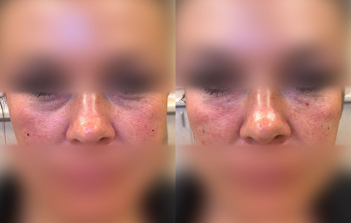 Tear Trough, Lower Lid, Filler Results at Maningas Cosmetic Surgery in Joplin, MO