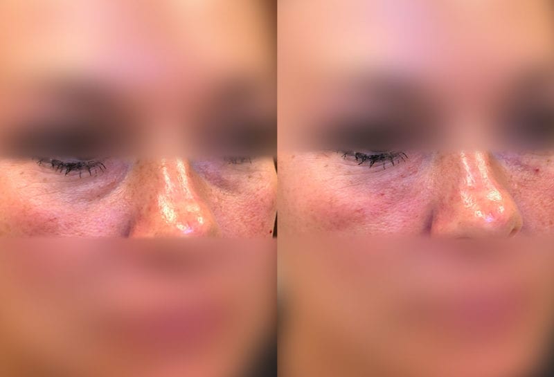 Tear Trough, Lower Lid, Filler Results at Maningas Cosmetic Surgery in Joplin, MO