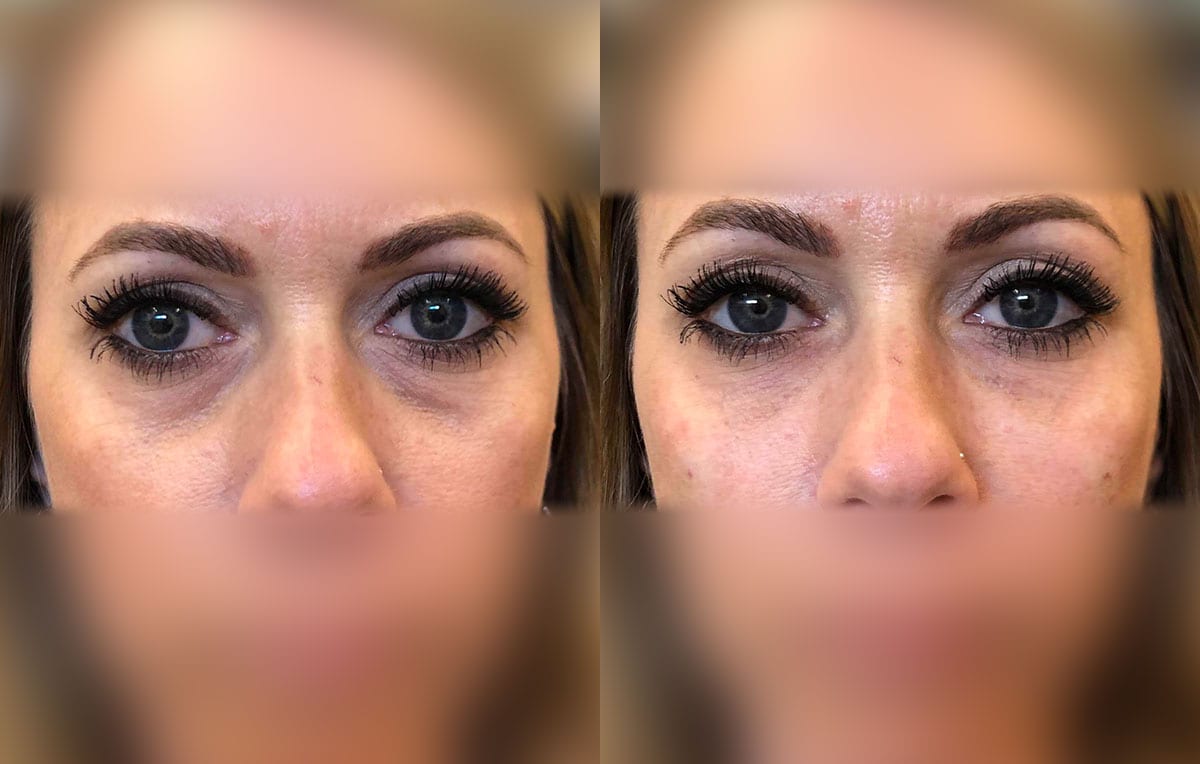 Tear Trough, Lower Lid, Filler Results at Maningas Cosmetic Surgery in Joplin, MO