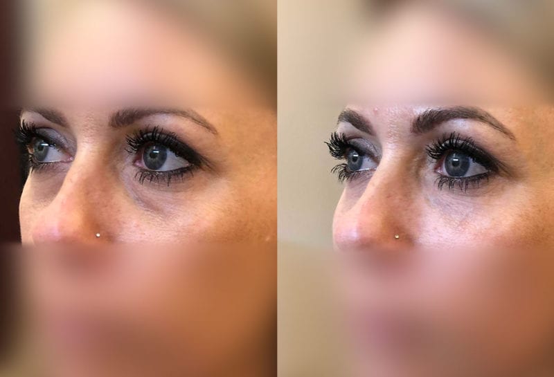 Tear Trough, Lower Lid, Filler Results at Maningas Cosmetic Surgery in Joplin, MO