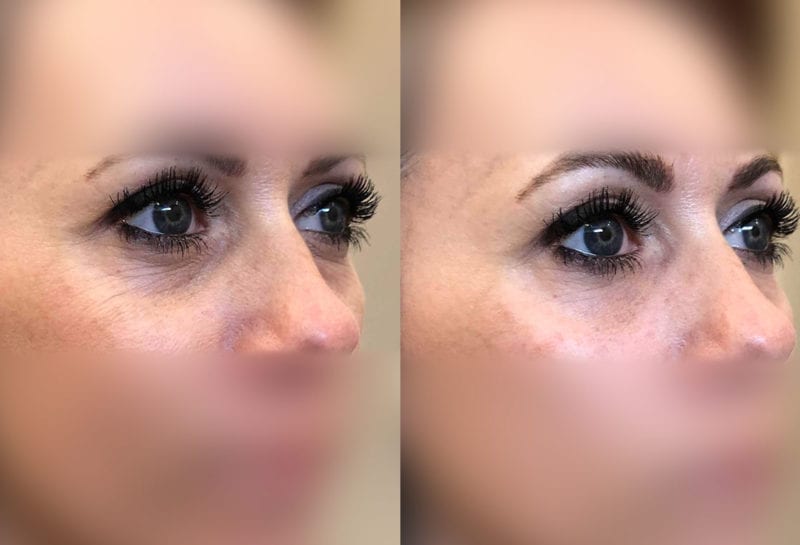 Tear Trough, Lower Lid, Filler Results at Maningas Cosmetic Surgery in Joplin, MO