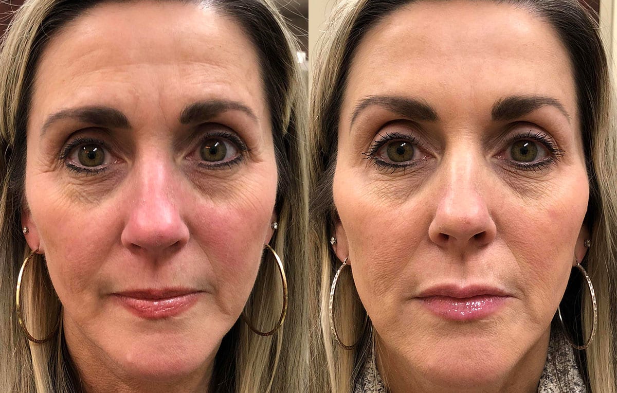 Non-Surgical Liquid facelift results at Maningas Cosmetic Surgery in Joplin, MO