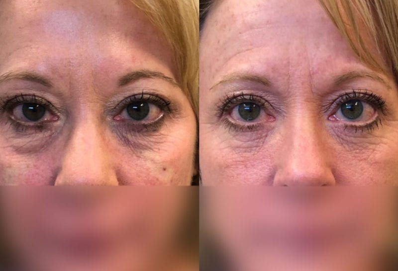 Tear Trough, Lower Lid, Filler Results at Maningas Cosmetic Surgery in Joplin, MO