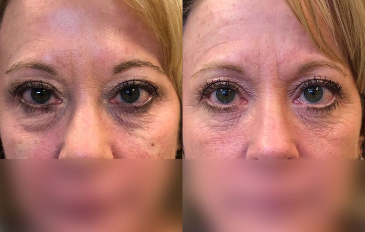 Tear Trough, Lower Lid, Filler Results at Maningas Cosmetic Surgery in Joplin, MO