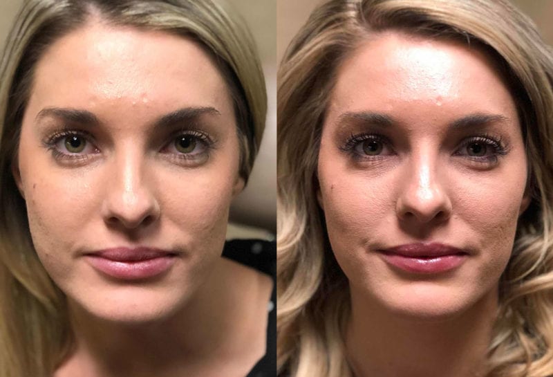 Cheek Filler Results at Maningas Cosmetic Surgery in Joplin, MO