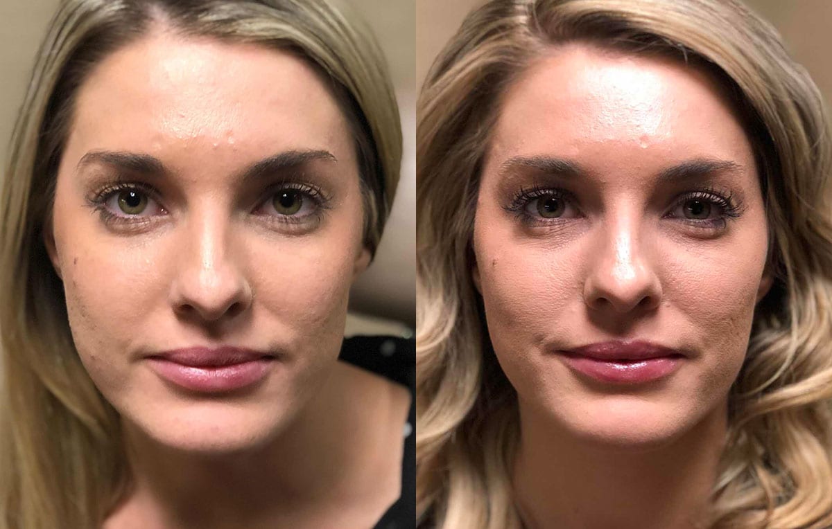 Cheek Filler Results at Maningas Cosmetic Surgery in Joplin, MO