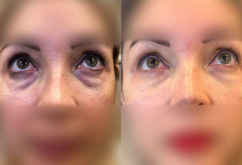 Tear Trough, Lower Lid, Filler Results at Maningas Cosmetic Surgery in Joplin, MO