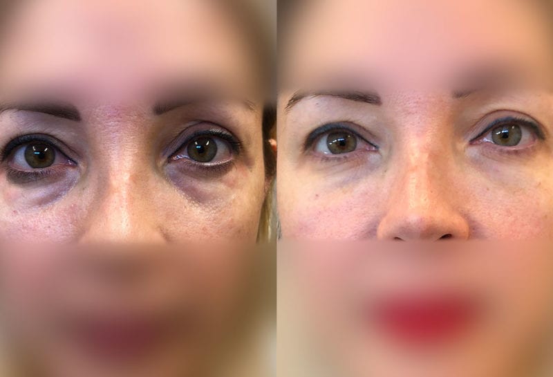 Tear Trough, Lower Lid, Filler Results at Maningas Cosmetic Surgery in Joplin, MO