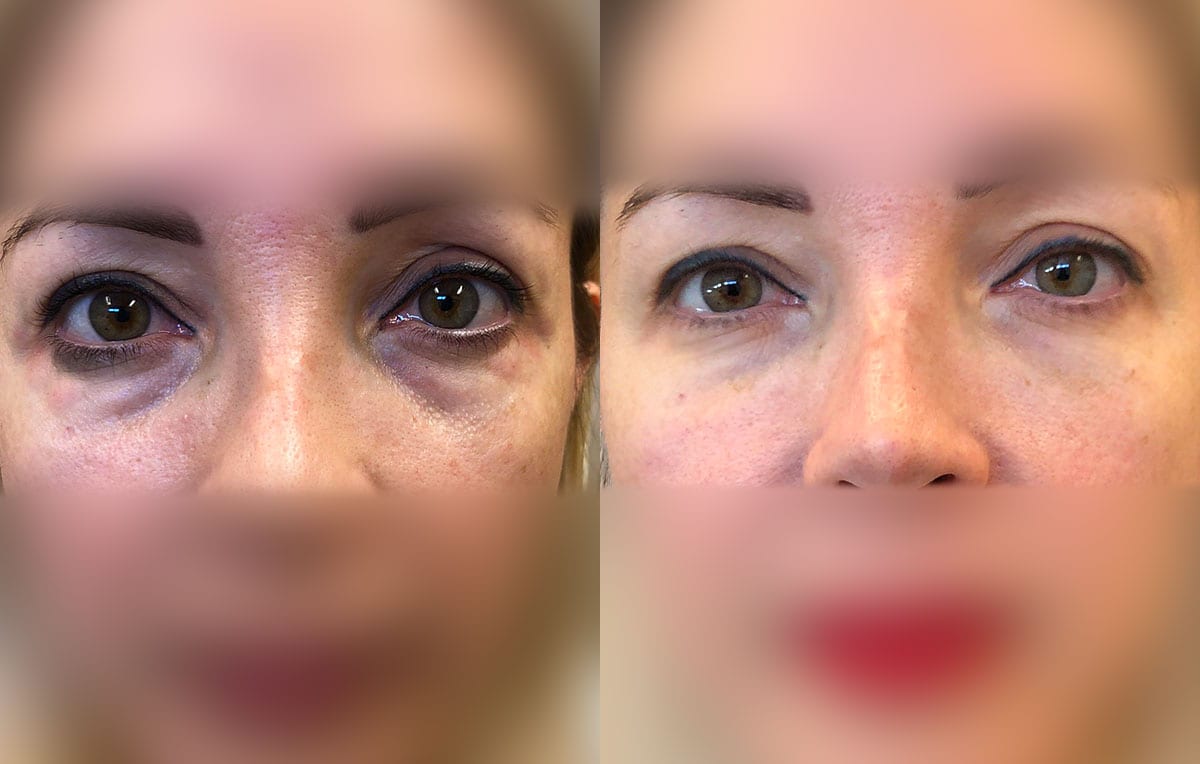 Tear Trough, Lower Lid, Filler Results at Maningas Cosmetic Surgery in Joplin, MO