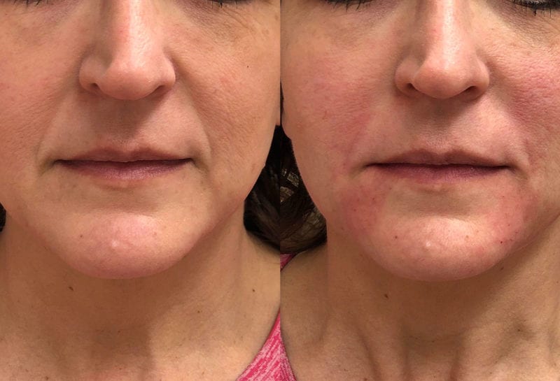 Lower Mouth Filler Results at Maningas Cosmetic Surgery in Joplin, MO