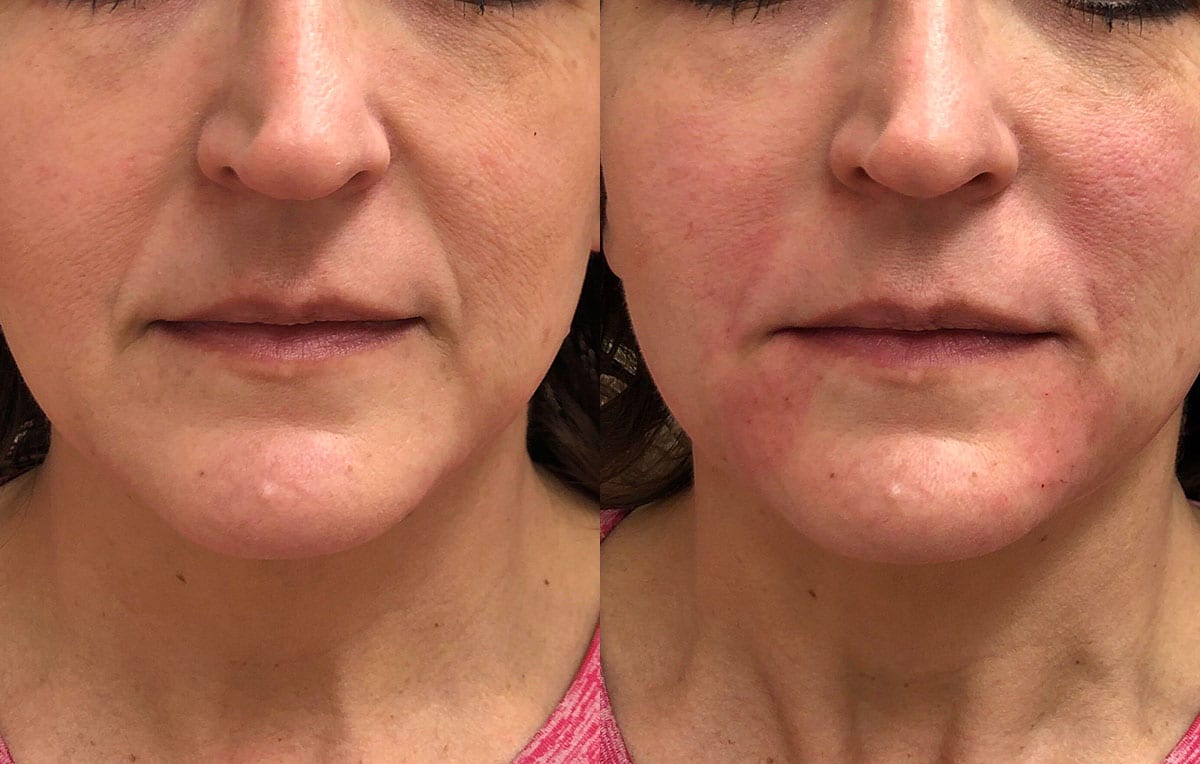 Lower Mouth Filler Results at Maningas Cosmetic Surgery in Joplin, MO