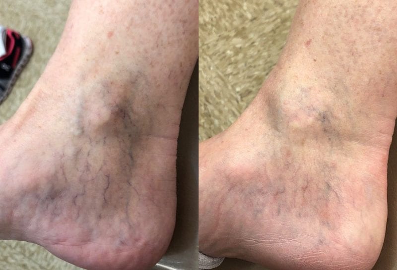 Sclerotherapy, or sider vein treatment, in Joplin, MO at Maningas Cosmetic Surgery to permanently remove small to medium sized leg spider veins