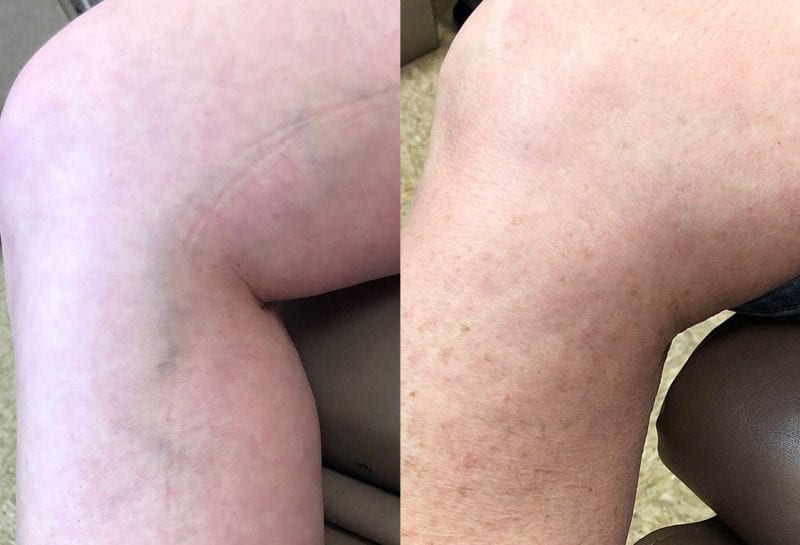 Sclerotherapy, or sider vein treatment, in Joplin, MO at Maningas Cosmetic Surgery to permanently remove small to medium sized leg spider veins