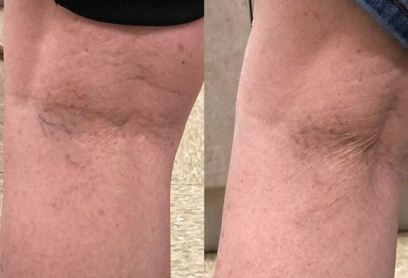 Sclerotherapy, or sider vein treatment, in Joplin, MO at Maningas Cosmetic Surgery to permanently remove small to medium sized leg spider veins