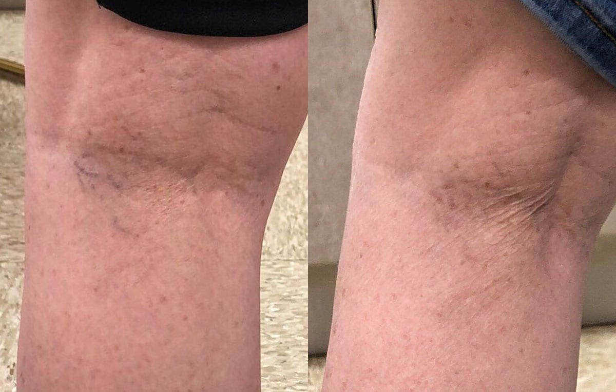 Sclerotherapy, or sider vein treatment, in Joplin, MO at Maningas Cosmetic Surgery to permanently remove small to medium sized leg spider veins