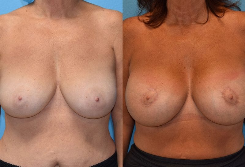 Benelli Breast Lift with Implant results by Dr. Maningas at Maningas Cosmetic Surgery in Missouri and Arkansas