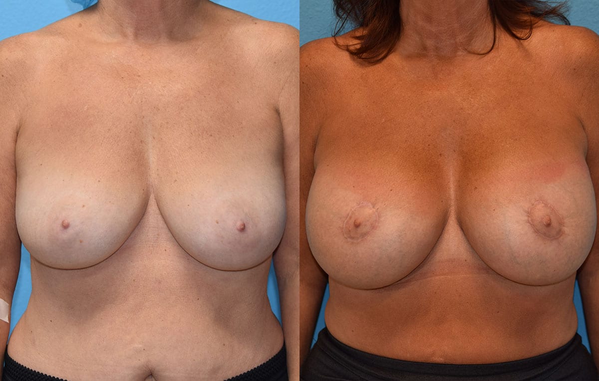 Benelli Breast Lift with Implant results by Dr. Maningas at Maningas Cosmetic Surgery in Missouri and Arkansas