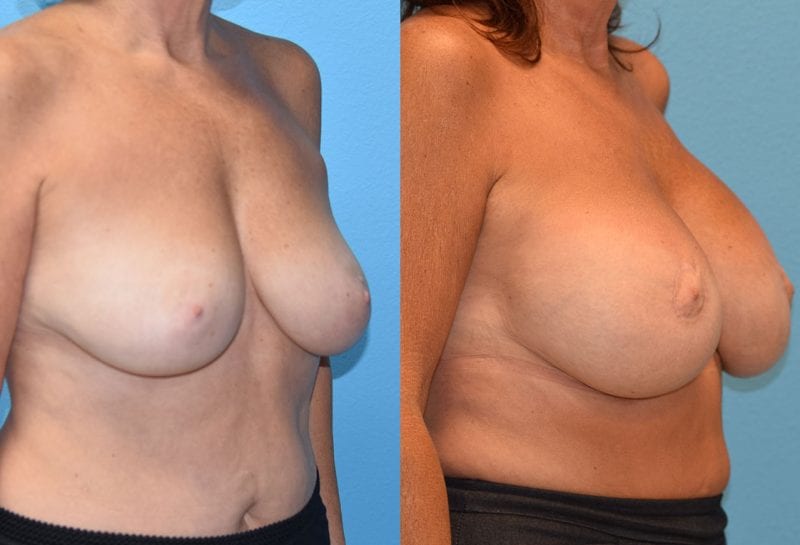 Benelli Breast Lift with Implant results by Dr. Maningas at Maningas Cosmetic Surgery in Missouri and Arkansas