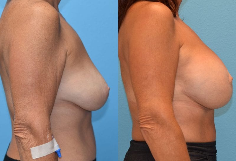 Benelli Breast Lift with Implant results by Dr. Maningas at Maningas Cosmetic Surgery in Missouri and Arkansas