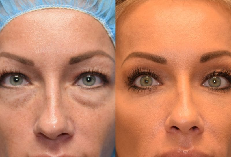 Lower eyelid surgery to remove under eye bags at Maningas Cosmetic Surgery in Joplin, MO and Northwest Arkansas