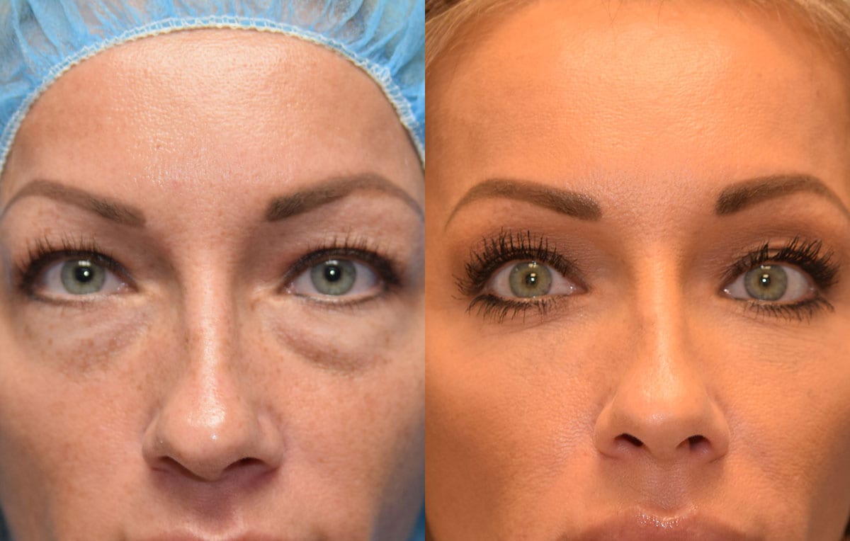 Lower eyelid surgery to remove under eye bags at Maningas Cosmetic Surgery in Joplin, MO and Northwest Arkansas