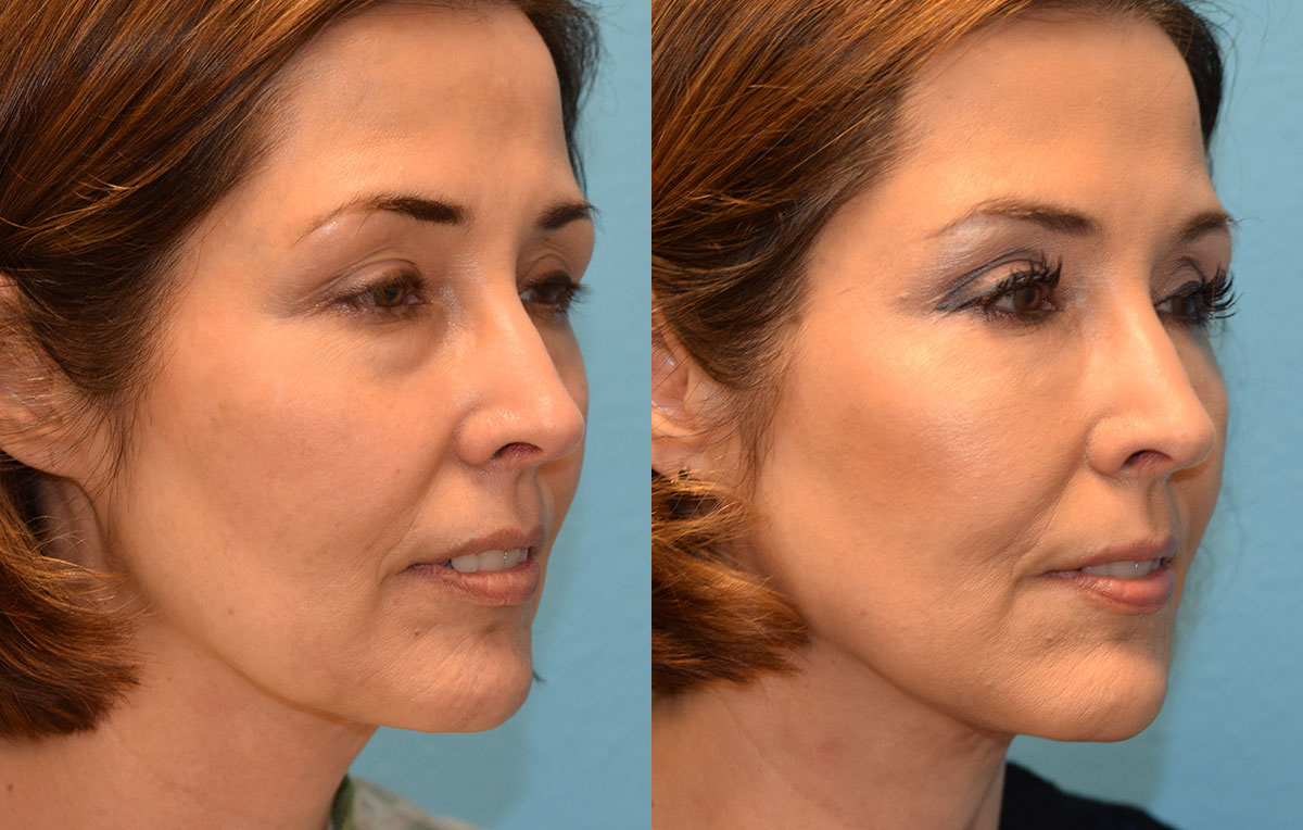 Facetite and Morpheus8, aka EmbraceRF, 4 month results at Maningas Cosmetic Surgery in Joplin, MO.