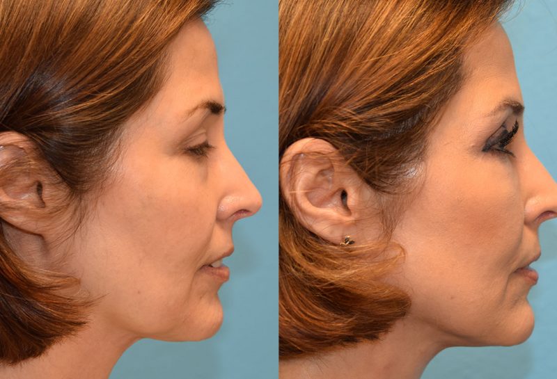 Facetite and Morpheus8, aka EmbraceRF, 4 month results at Maningas Cosmetic Surgery in Joplin, MO.