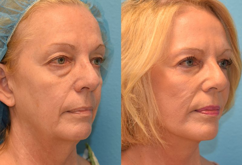 Facelift results at Maningas Cosmetic Surgery in Joplin, MO and Northwest Arkansas