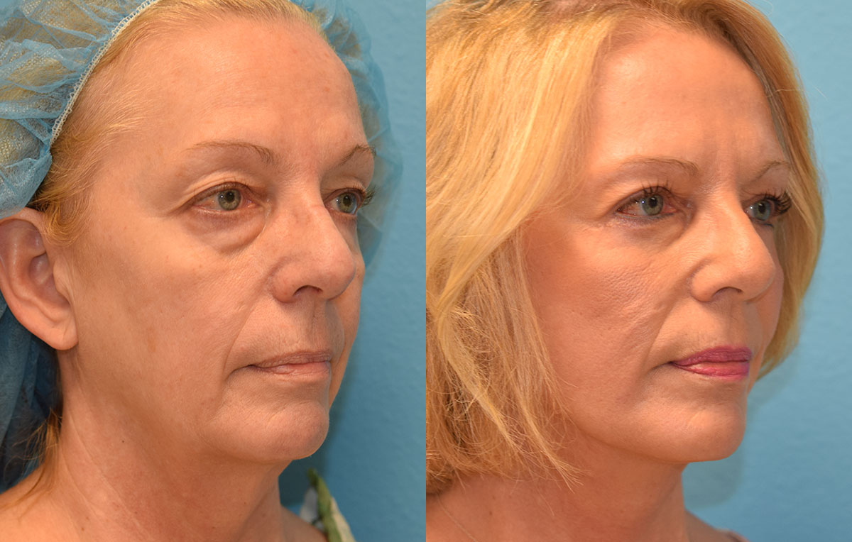 Facelift results at Maningas Cosmetic Surgery in Joplin, MO and Northwest Arkansas