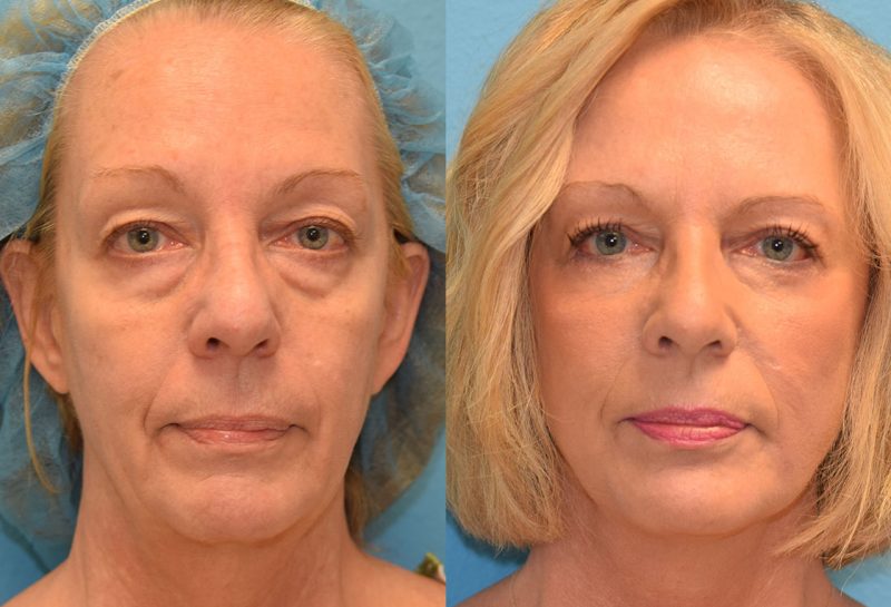 Facelift results at Maningas Cosmetic Surgery in Joplin, MO and Northwest Arkansas