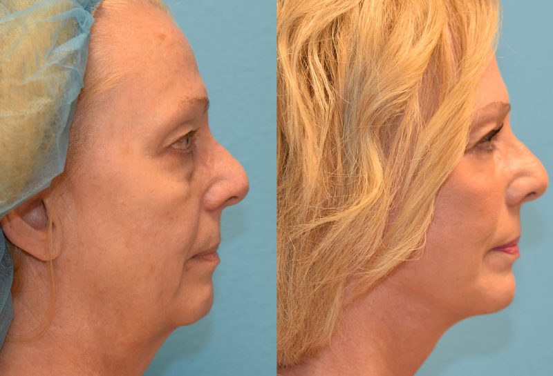 Facelift results at Maningas Cosmetic Surgery in Joplin, MO and Northwest Arkansas