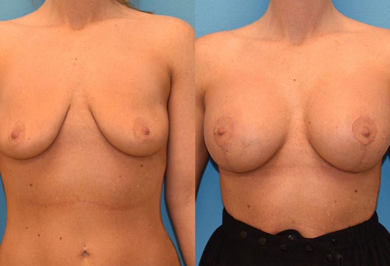 Breast augmentation with a lift results by Dr. Maningas at Maningas Cosmetic Surgery in Missouri and Arkansas