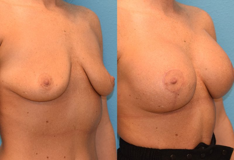 Breast augmentation with a lift results by Dr. Maningas at Maningas Cosmetic Surgery in Missouri and Arkansas