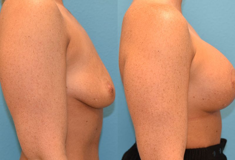 Breast augmentation with a lift results by Dr. Maningas at Maningas Cosmetic Surgery in Missouri and Arkansas