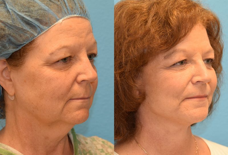 Facelift results at Maningas Cosmetic Surgery in Joplin, MO and Northwest Arkansas