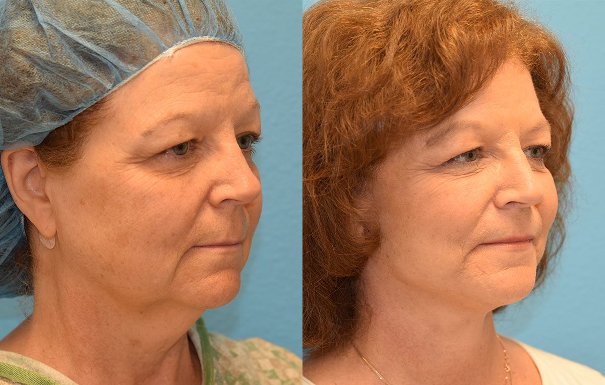 Facelift results at Maningas Cosmetic Surgery in Joplin, MO and Northwest Arkansas