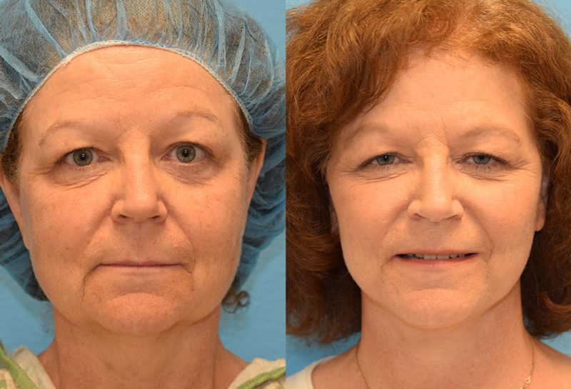 Facelift results at Maningas Cosmetic Surgery in Joplin, MO and Northwest Arkansas