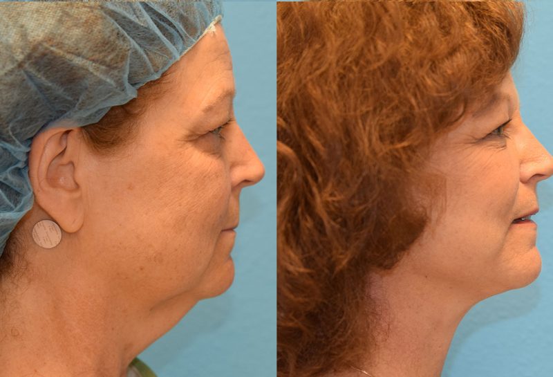 Facelift results at Maningas Cosmetic Surgery in Joplin, MO and Northwest Arkansas