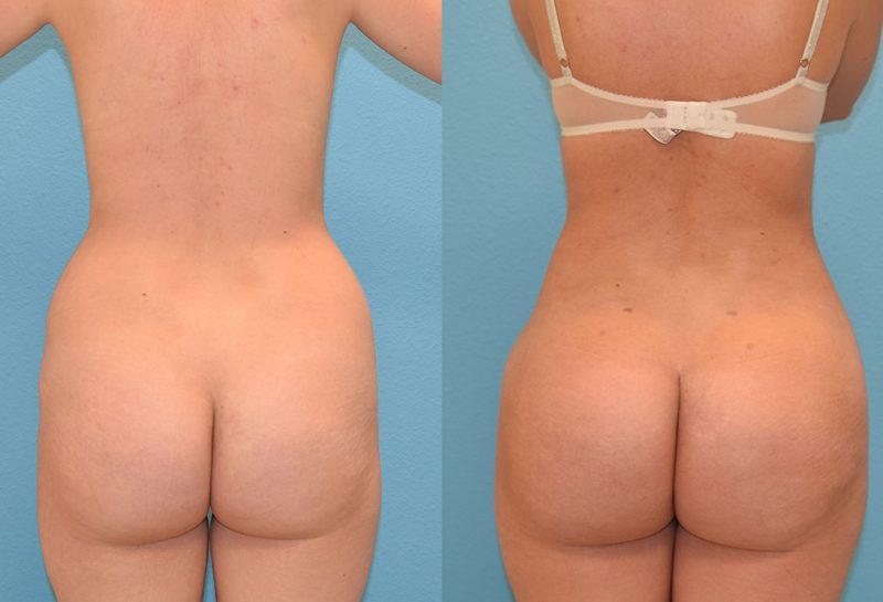 Brazilian Butt Lift by Dr. Maningas at Maningas Cosmetic Surgery in Joplin, MO