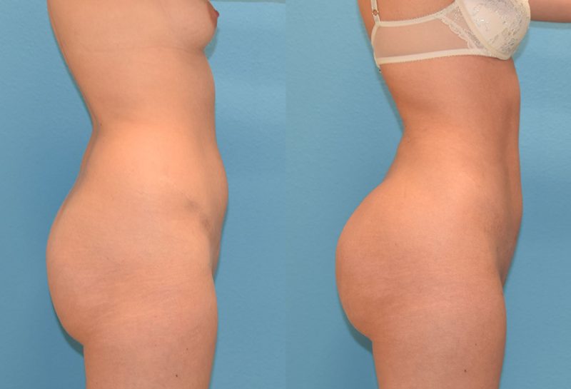 Brazilian Butt Lift by Dr. Maningas at Maningas Cosmetic Surgery in Joplin, MO