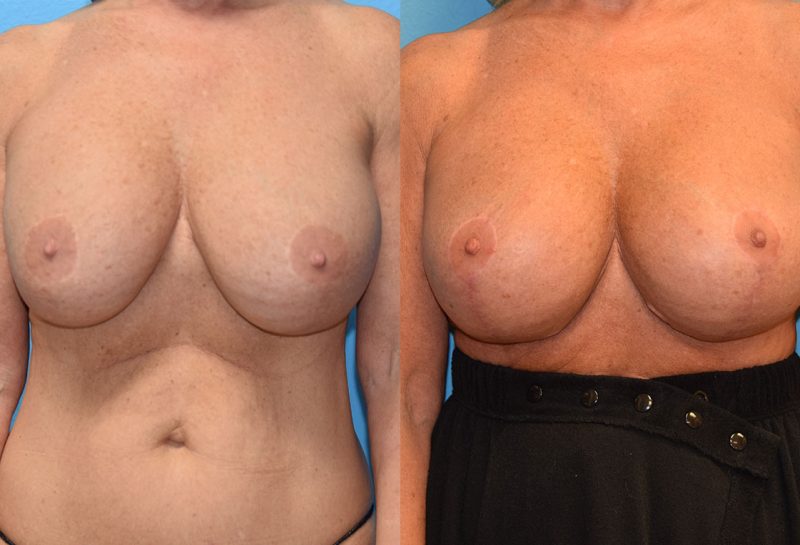 Breast augmentation with a lift results by Dr. Maningas at Maningas Cosmetic Surgery in Missouri and Arkansas