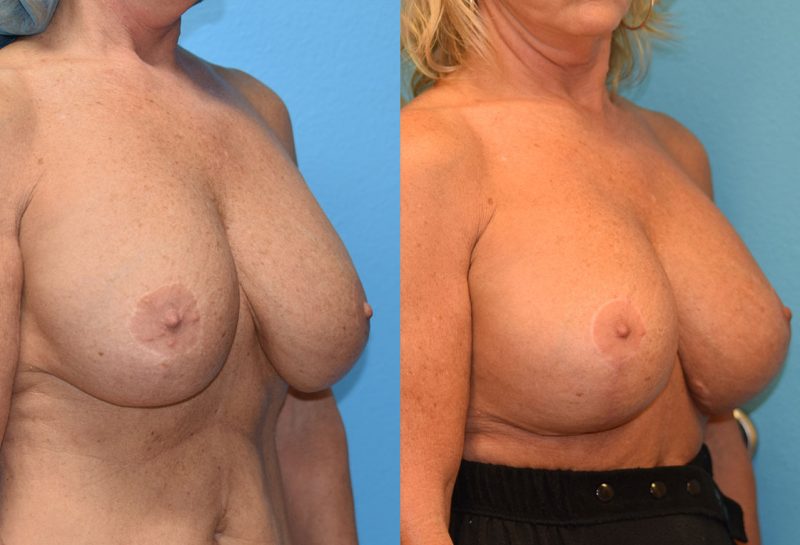 Breast augmentation with a lift results by Dr. Maningas at Maningas Cosmetic Surgery in Missouri and Arkansas