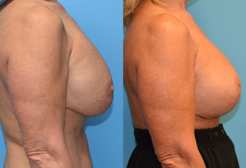 Breast augmentation with a lift results by Dr. Maningas at Maningas Cosmetic Surgery in Missouri and Arkansas