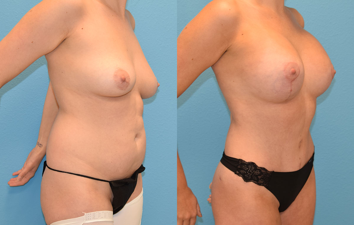 Mommy Makeover results by Dr. Maningas at Maningas Cosmetic Surgery in Joplin, MO