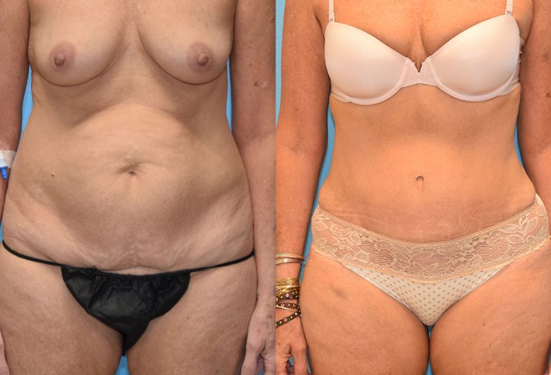 Tummy Tuck results by Dr. Maningas at Maningas Cosmetic Surgery in Missouri and Arkansas