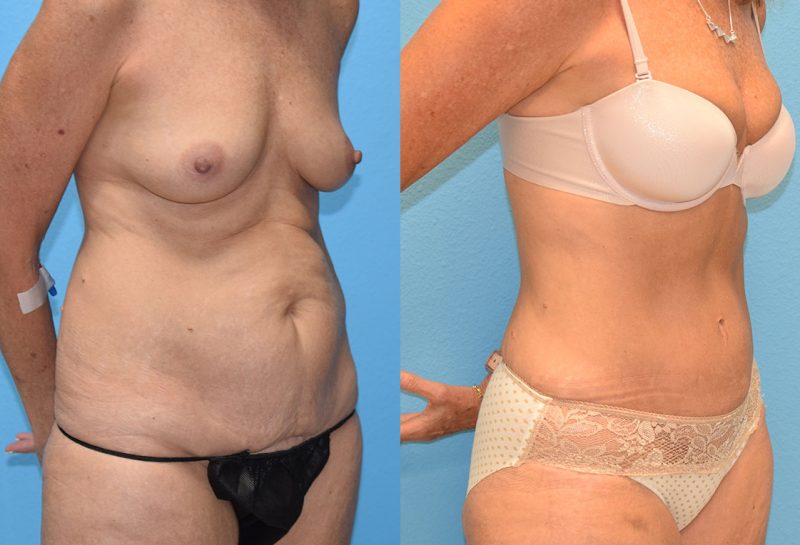 Tummy Tuck results by Dr. Maningas at Maningas Cosmetic Surgery in Missouri and Arkansas